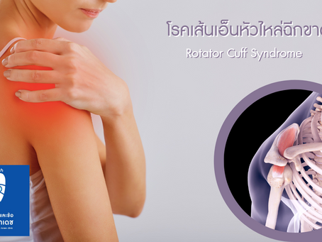 เอ็นหัวไหล่ฉีกขาด (Rotator cuff syndrome)