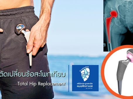 การผ่าตัดเปลี่ยนข้อสะโพกเทียม (Total hip replacement)