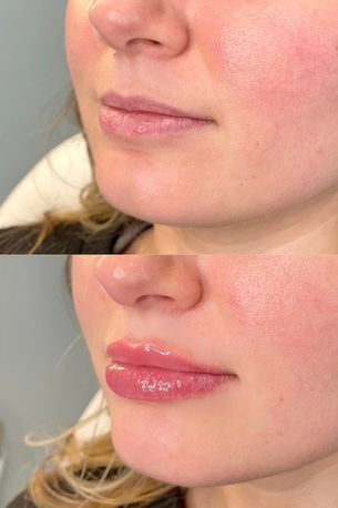 Juvederm VolbellaXC