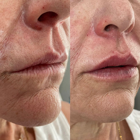 lip filler 2.JPG