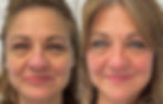 Fibroblast Facelift