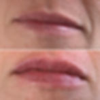 HA Lip Filler