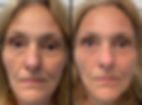 Fibroblast facelift