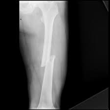 A Broken Bone is Painful!