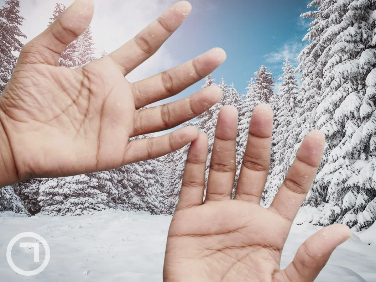 Banishing Dry Hands A Comprehensive Guide to Prevention, Treatment