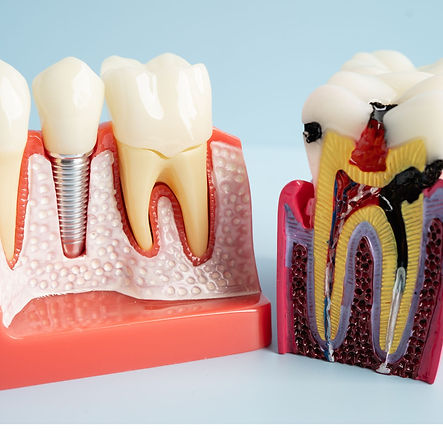 Zirconia (3).jpg