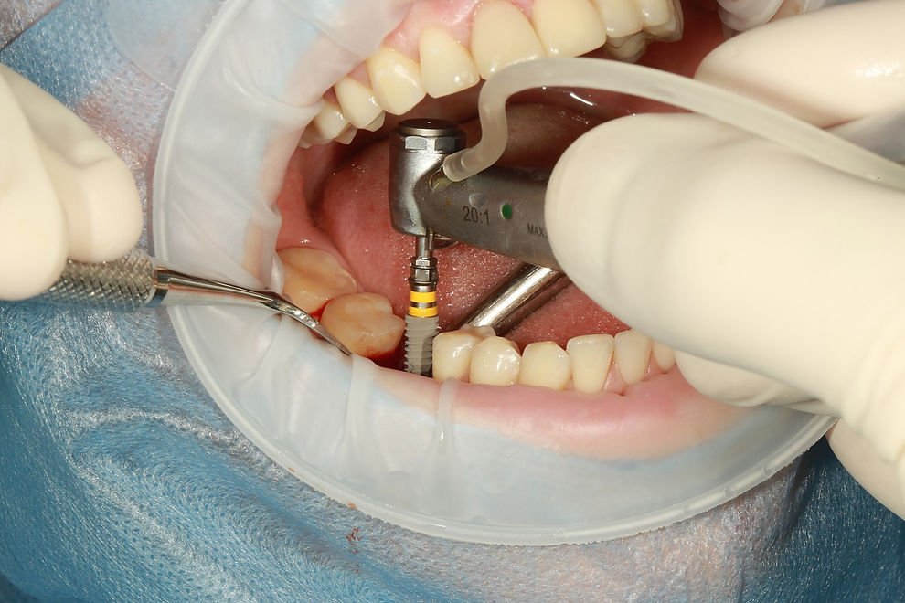 dental-implant.jpeg