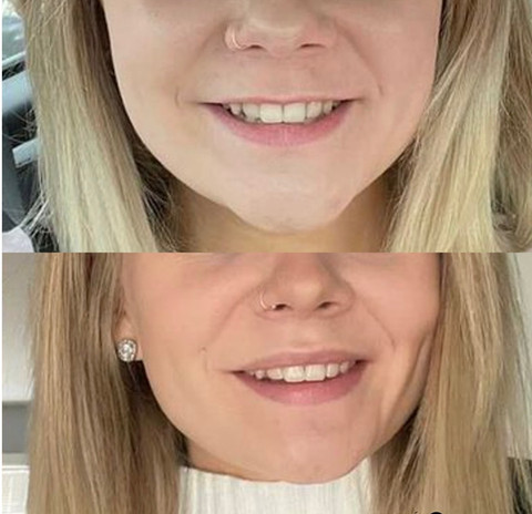 Before & After White Lotus Medical Aesthetics