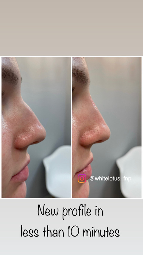Before & After White Lotus Medical Aesthetics