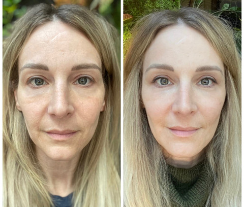 Before & After White Lotus Medical Aesthetics