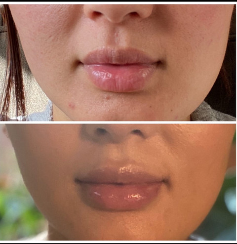 Before & After White Lotus Medical Aesthetics