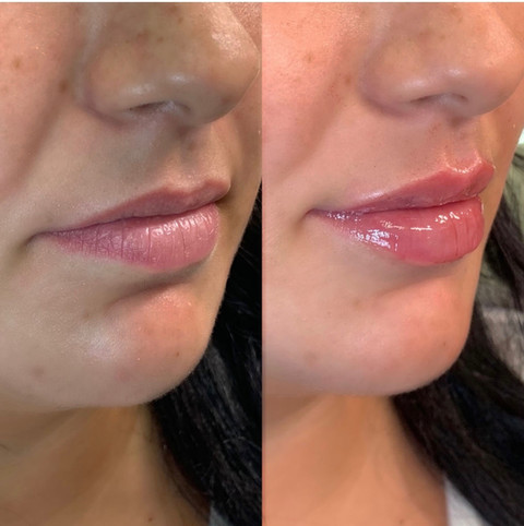 Before & After White Lotus Medical Aesthetics