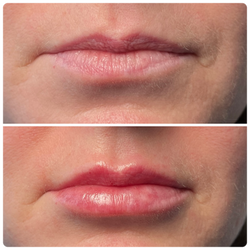 Lip Filler