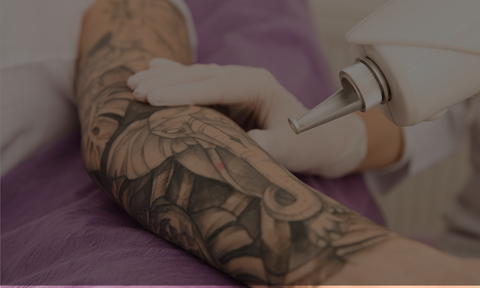 tattoo removal2.png