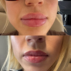 Lip dissolving/Hylenex