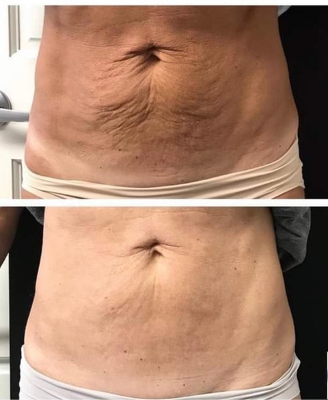 Before & After White Lotus Medical Aesthetics