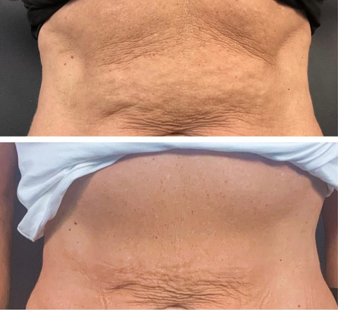 Before & After White Lotus Medical Aesthetics