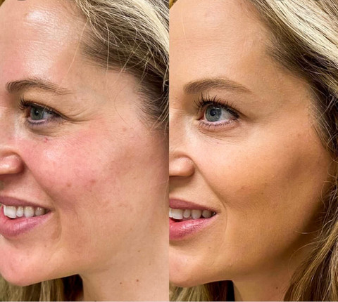 Before & After White Lotus Medical Aesthetics
