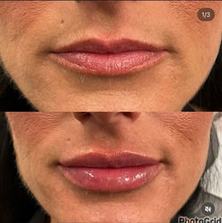Lip Filler