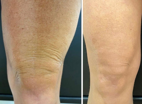 Before & After White Lotus Medical Aesthetics