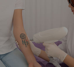 tattoo removal_edited.jpg