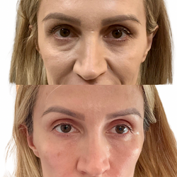 Sculptra, Potenza, EzGel