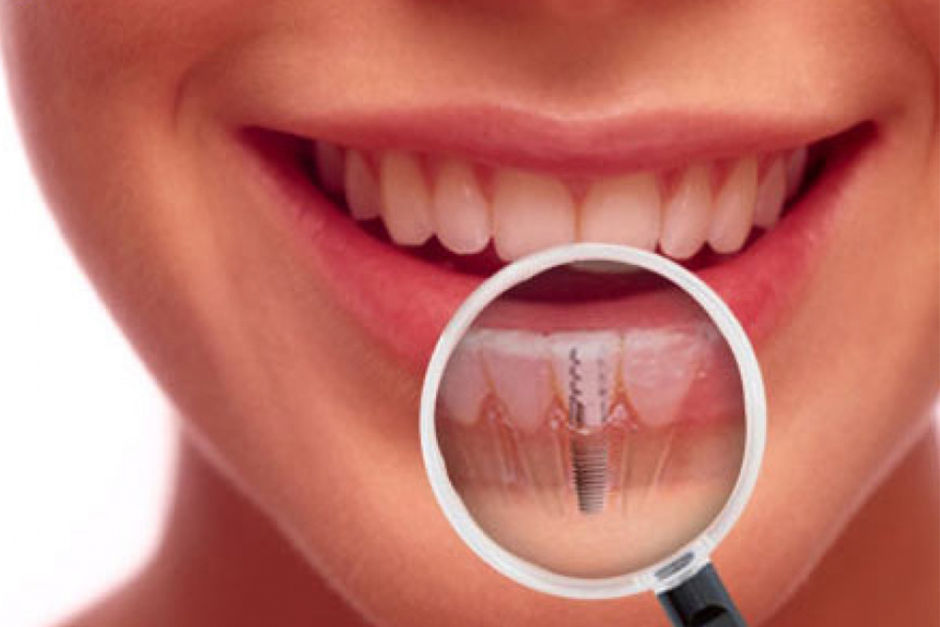 Cấy ghép răng implant có đau không?