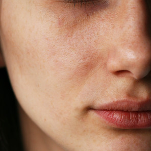 How to get rid of blackheads and keep them away