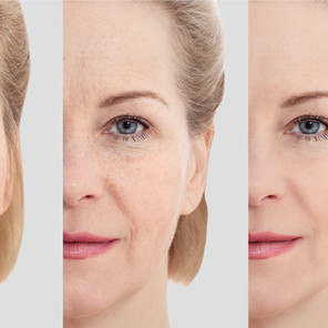 5 Things You Need to Know about Platelet Rich Plasma (PRP)