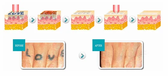 Eliminacion-tatuajes-prat.webp