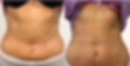 EMS Body Sculpting on the abdomen 3