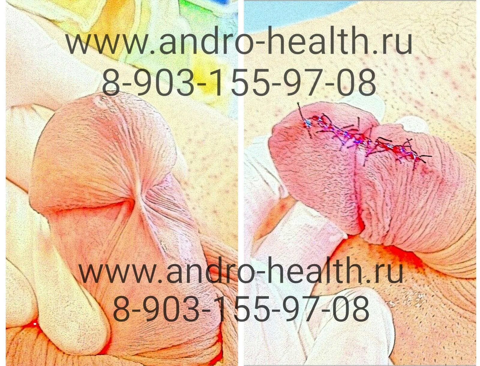 уздечка операция член Операция член уздечка