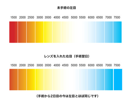 映像制作マンが多焦点眼内レンズを入れたら(その2)