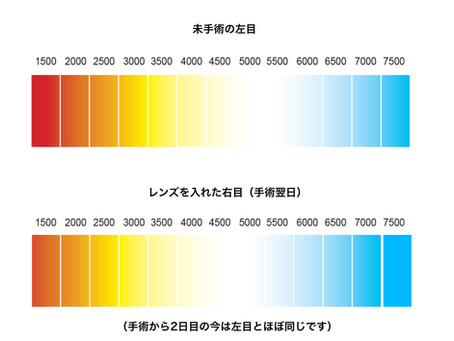 映像制作マンが多焦点眼内レンズを入れたら(その2)