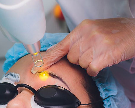 eyebrow tattoo removal.JPG