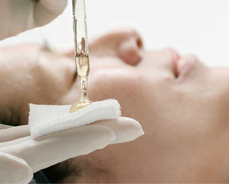 chemical peel.PNG