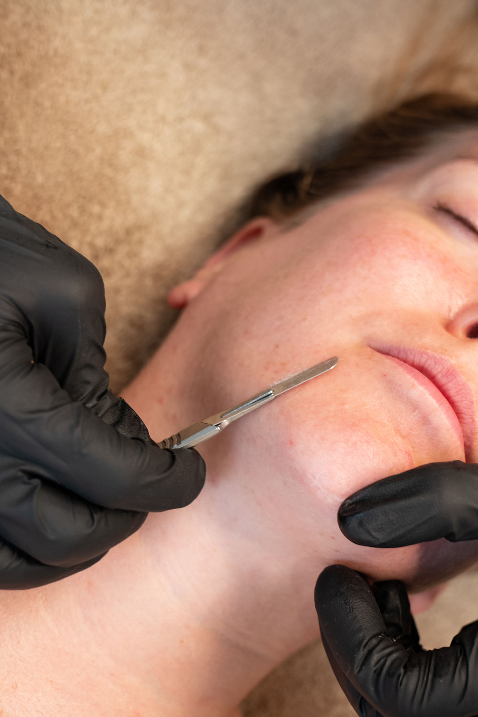 dermaplaning face treatment