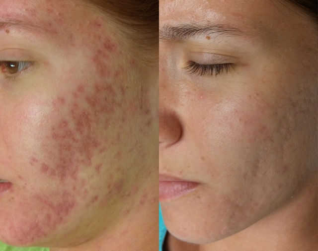 SkinPen before and after for acne scarring
