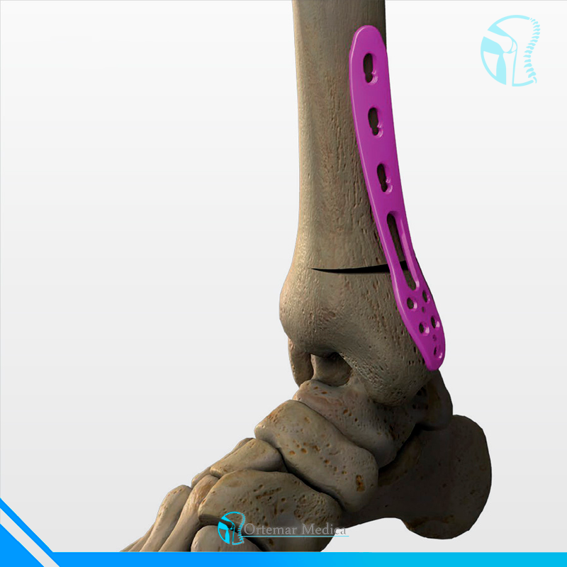 Placa para osteotomía de tibia distal
