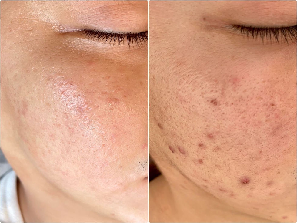 ニキビ施術例