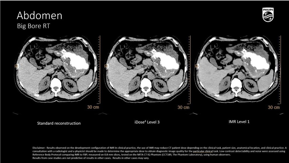 КТ изображение Philips CT Big Bore RT