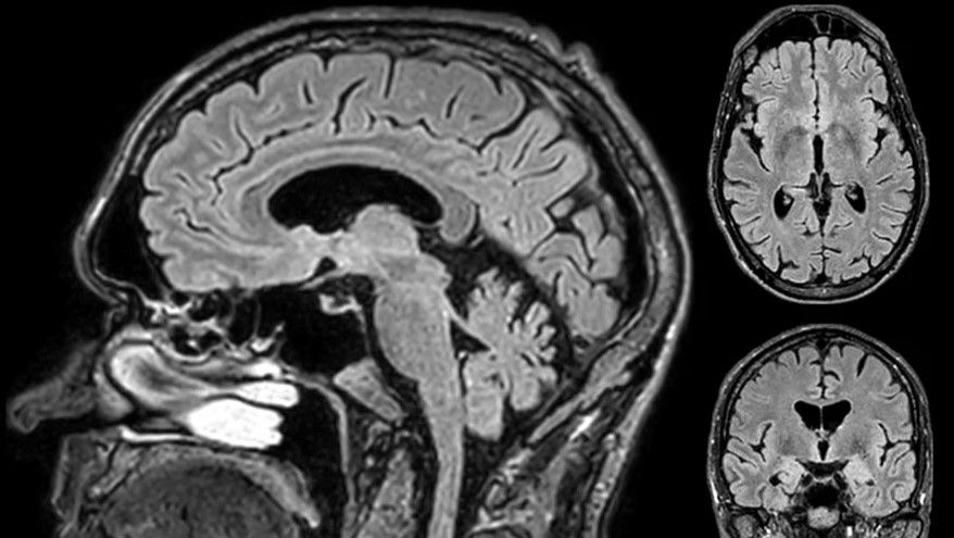 МРТ изображение Philips MR 5300