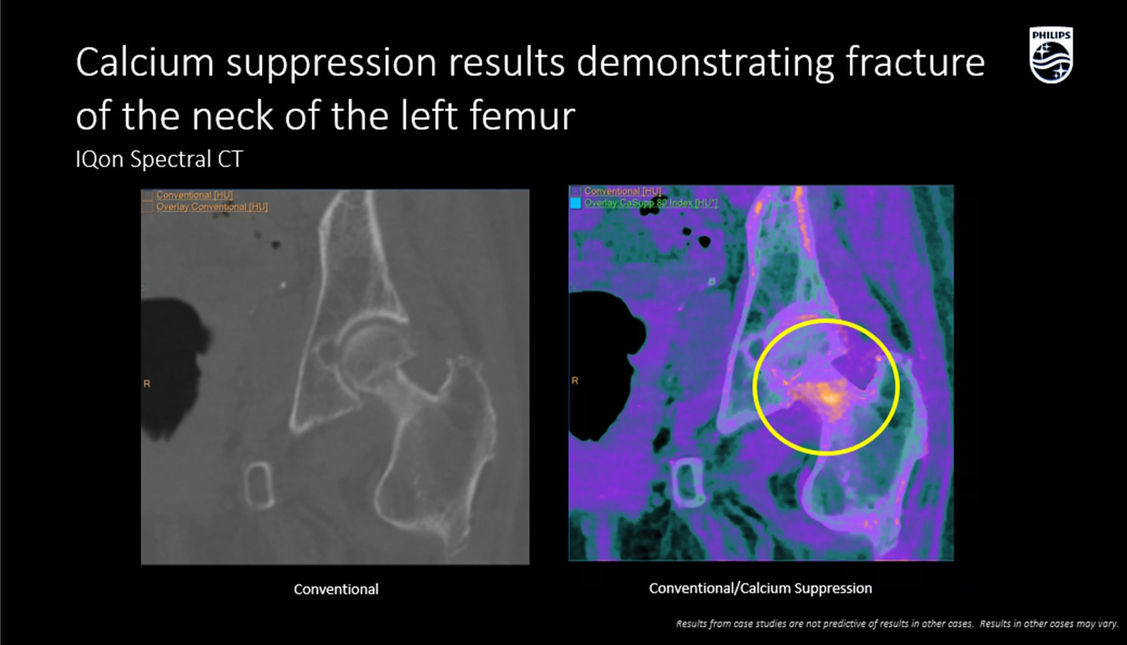 КТ изображение Philips IQon Spectral CT