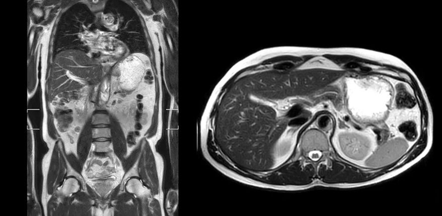 МРТ изображение Philips MR 5300