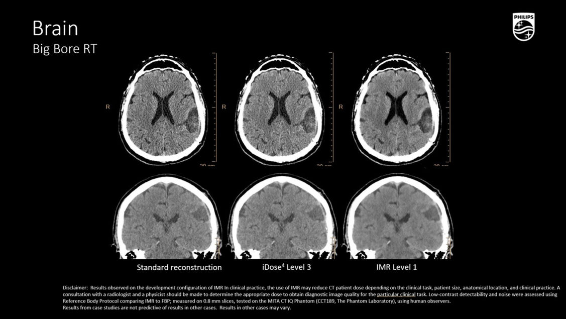 КТ изображение Philips CT Big Bore RT