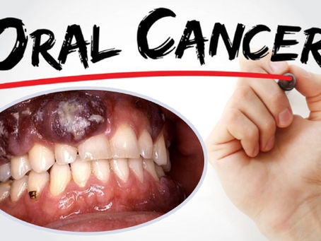 April is Oral Cancer Month: Let's Raise Awareness Together!