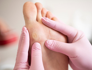 Callus Removal Singapore.jpg