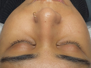 Why Dermaplaning Is the Glow-Up Your Skinās Been Waiting For š
