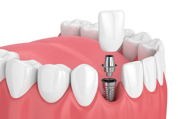 dental-implants