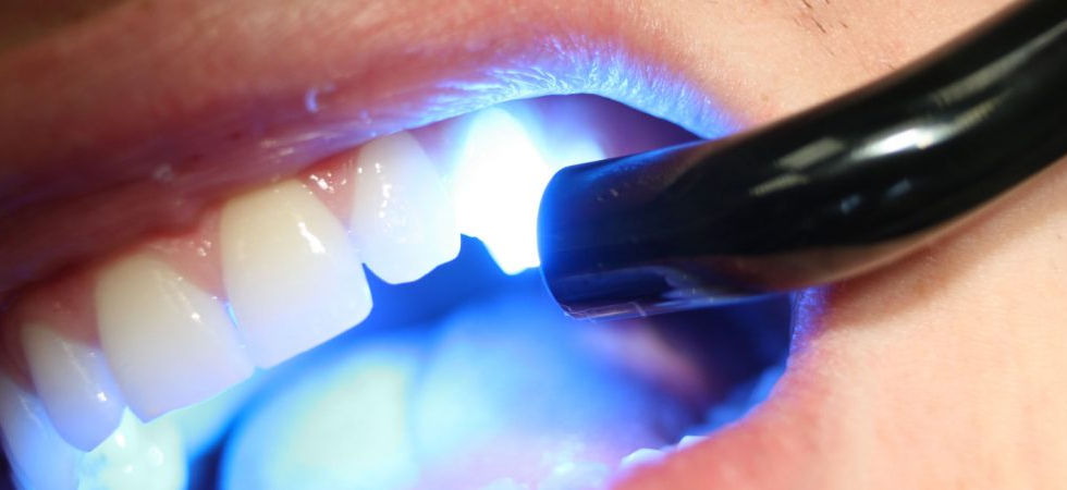 Composite Fillings